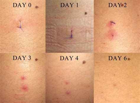Patch Testing To Vicryl Sutures Daily Chronological Sequence Of