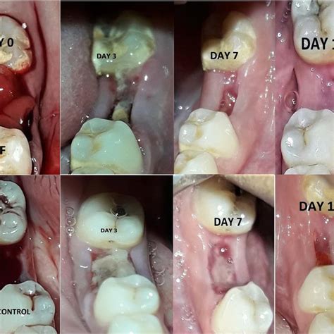 Extraction Site Healing 1 Week After Tooth Removal Note The Visibility Download Scientific