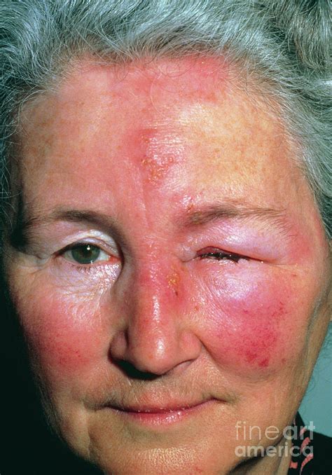 Herpes Zoster Shingles Affecting Nerve Of Face Photograph By Dr Hc