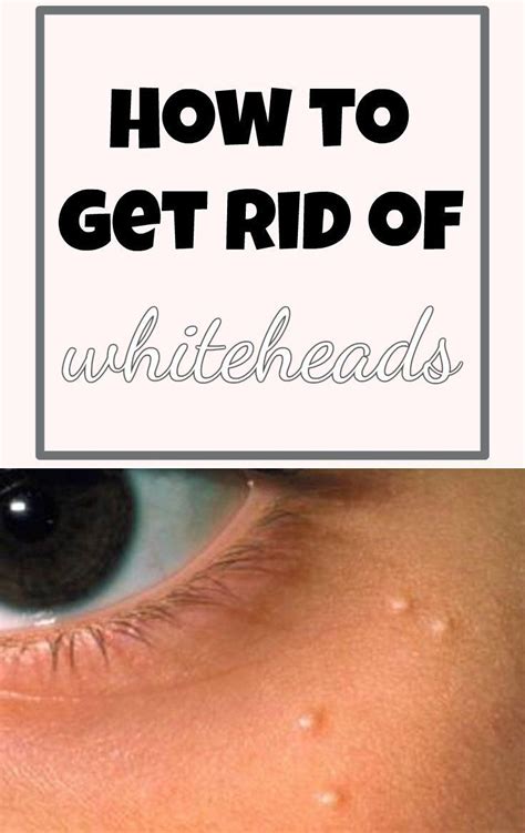 Learn How To Get Rid Of Whiteheads Howtoclearwhiteheads Healthy