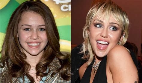 Celebrities With Braces Before And After Famous Brace Faces