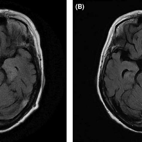 A Initial Magnetic Resonance Imaging Findings T2 Weighted