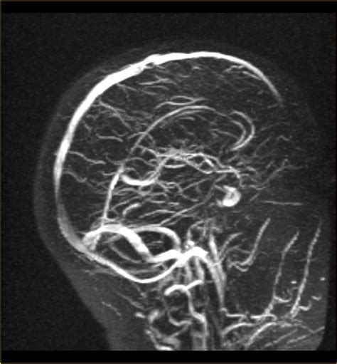 Learn vocabulary, terms and more with flashcards, games and other study tools. Datei:Mr cranial sinusvene.jpg - Wikipedia