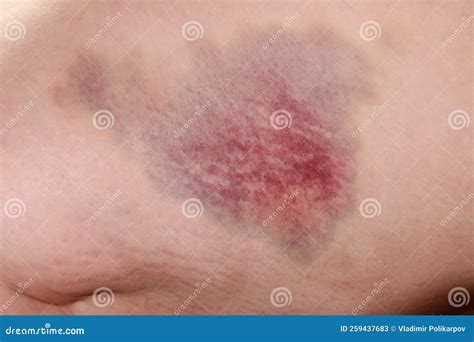 Large Bruise Of A Yellow Hematoma On The Thigh Royalty Free Stock Photo
