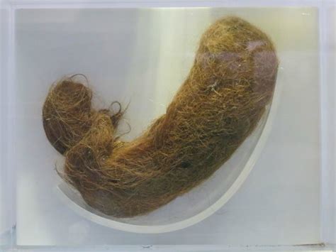 human hairball picture of national museum of health and medicine washington dc tripadvisor