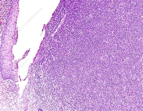 Diffuse Large B Cell Lymphoma Light Micrograph Stock Image C046