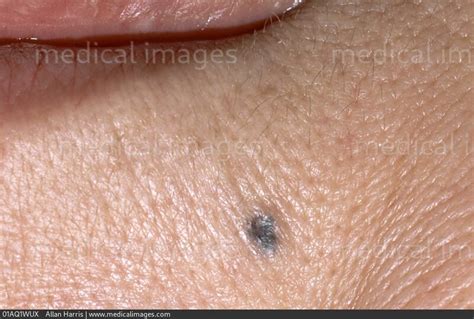 Stock Image Dermatology Pigmented Basal Cell Carcinoma A Small Rounded