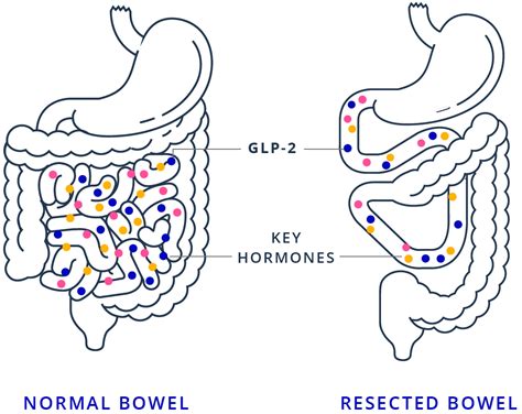 What Is Short Bowel Syndrome Sbs