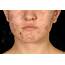 Skin Problems And How To Treat Them Acne Eczema
