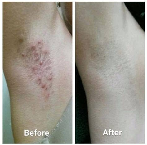 Sometimes they just look like small red pimples with no discharge, while in more severe cases (ingrown hair cysts, boils, cutaneous pili migrans) the whole area is cleaned, and antibiotics are applied topically to the wound to prevent acute infection. Collection of What Do Ingrown Hairs Look Like | Best Ways ...