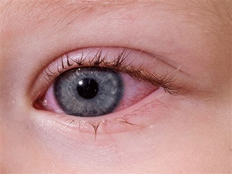 Eye Infection, Red Eye | Jamison Optical