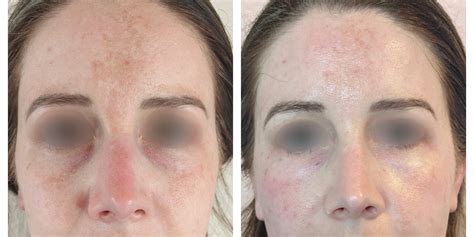 Skin Boosters And Bio Remodelling Ashleighs Aesthetics
