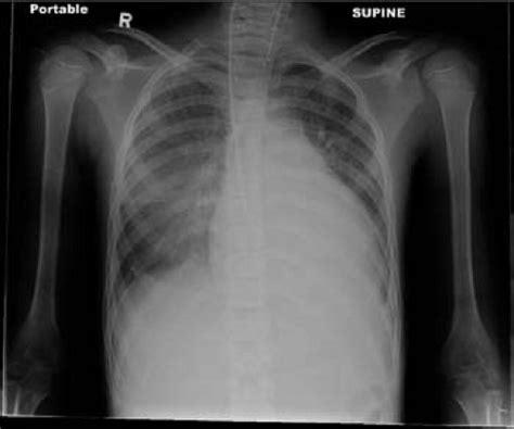 Myocarditis care at mayo clinic. Myocarditis | Thoracic Key