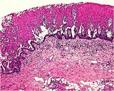 Suprabassl Acantholysis With Acantholytic Cells Hyperacanthosis And