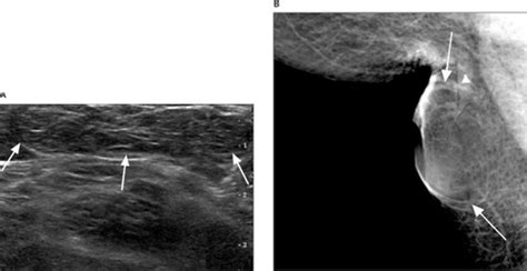 Sonographic Findings Of Axillary Masses Park 2013 Journal Of
