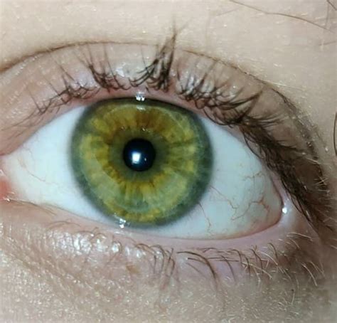 Anyone Else Have Constant Glassy Eyes Eyes