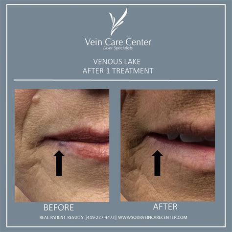 Venous Lake Before And After Lima Ohio Vein Care Center
