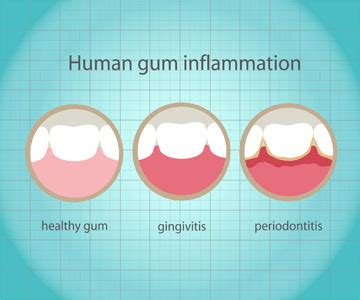 What Are The Causes And Symptoms Of Gum Disease Diamond Head Dental