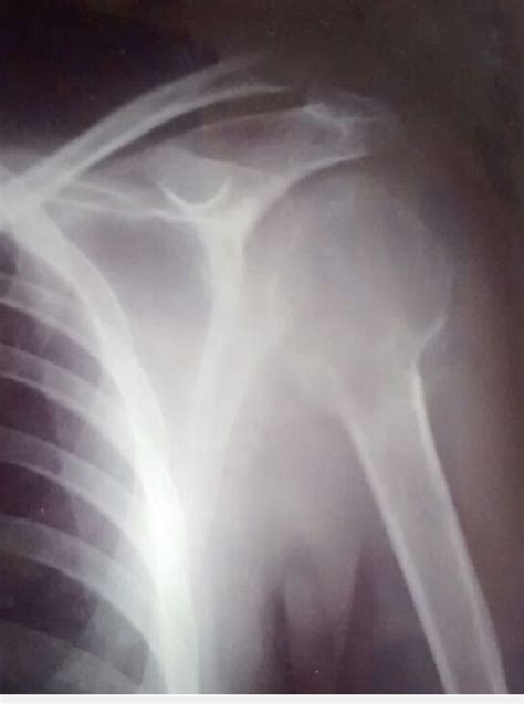 Anteroposterior Radiograph Of The Left Shoulder Case 1 Showing A