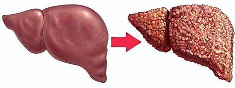 Неалкогольный жировой гепатоз диета Жировой гепатоз печени: симптомы и лечение - highpigpape Жировой гепатоз печени: симптомы и лечение - highpigpape Неалкогольный жировой гепатоз диета