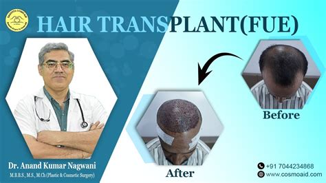 Fue Hair Transplant Cost Of Hair Transplant Lowest Cost Hair Transplant Cheapest Best