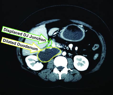 Transverse View Of Ct Scan Abdomen Showing Dilated Duodenum And