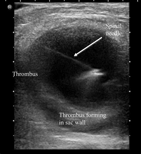 A Painful Swelling In The Groin The Bmj