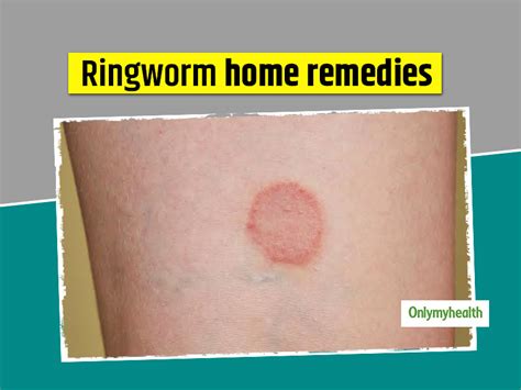 Here Are 10 Home Remedies And Tips To Prevent Ringworm Onlymyhealth
