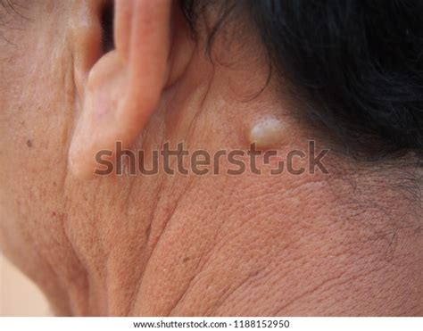 Sebaceous Cyst On Neck Man Form Stock Photo Edit Now 1188152950