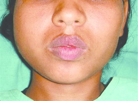 Swelling On One Side Of Face And Lips
