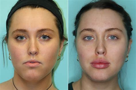 lip augmentation before and after photos page 5 of 6 the naderi center for plastic surgery