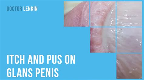 😲 Itch And Pus On Glans Penis Youtube