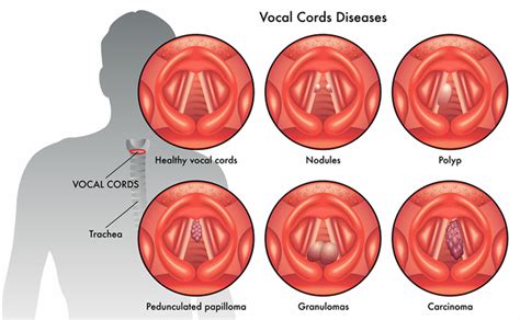 Vocal Cord Nodule Uc Irvine Medical Center