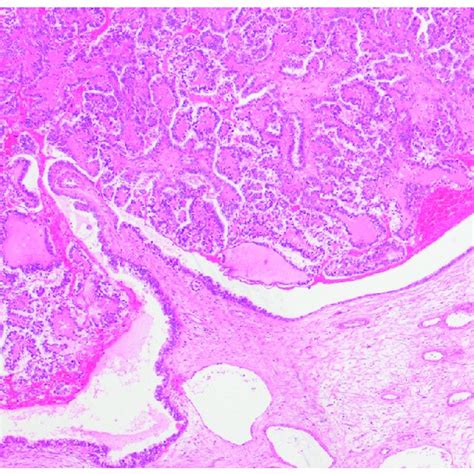 Clear Cell Carcinoma Of The Ovary Arising In The Lumen Of An