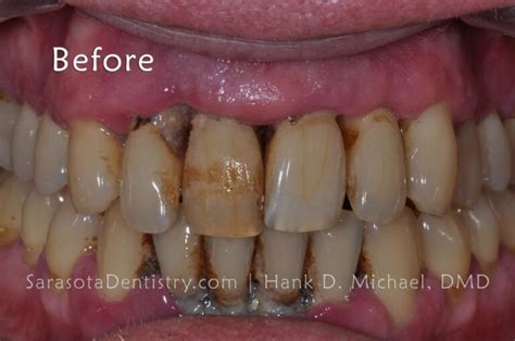 How To Fix Receding Gums From Getting Worse Sarasota Dentistry