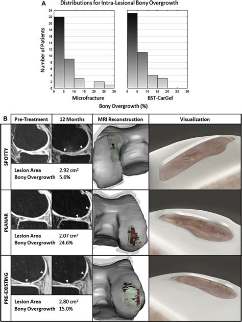 Quantitative 3d Mri Reveals Limited Intra Lesional Bony Overgrowth At 1