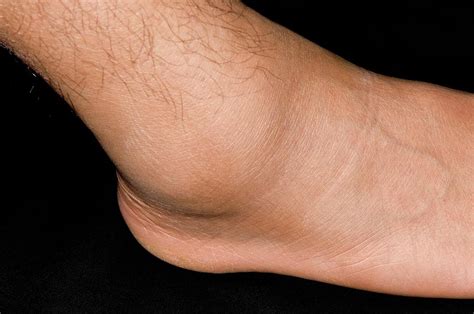 Sprained Ankle Sport S Injury Photograph By Dr P Marazzi Science Photo Library
