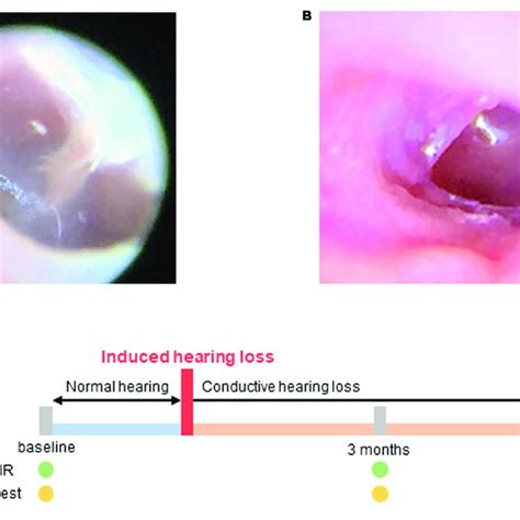 Hearing Loss Was Induced By Resection Of The Tympanic Membrane A
