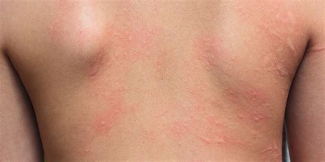 Allergic Contact Dermatitis Treatment Norris Dermatology Portland Or