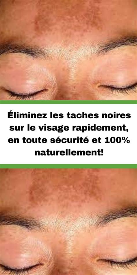 Éliminez Les Taches Noires Sur Le Visage Rapidement En Toute Sécurité