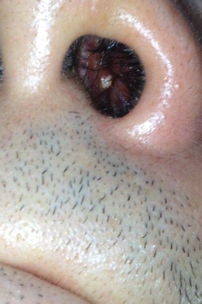 Is A White Little Bump Inside Of Nostril An Infection Photo Doctor