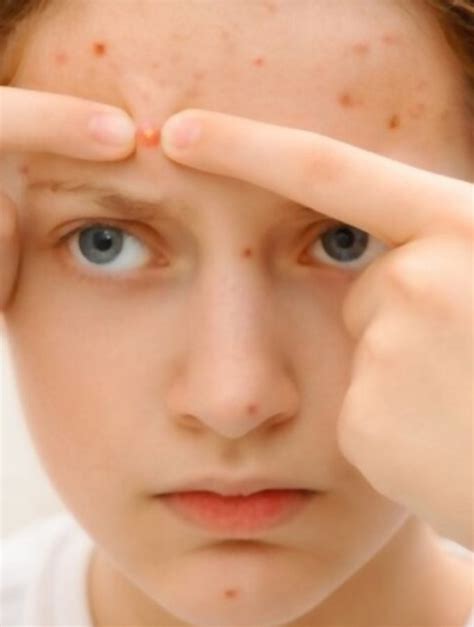 How To Treat Cystic Pimple On Forehead Causes And Prevention