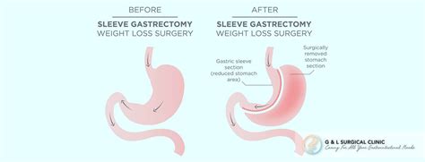 Laparoscopic Sleeve Gastrectomy G And L Surgical Clinic