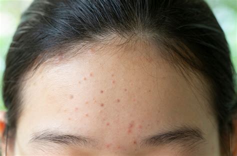 Forehead Acne Practical Tips From A Dermatologist
