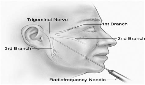 The Surgical Treatment Of Trigeminal Neuralgia Overview And