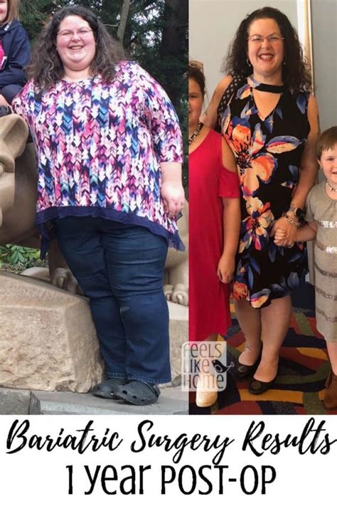Bariatric Gastric Sleeve Surgery Update And Results 1 Year Post Op
