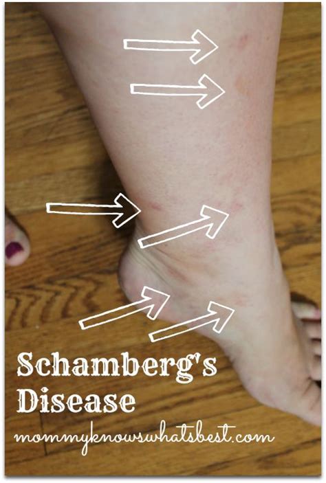 What is Schamberg's Disease During Pregnancy