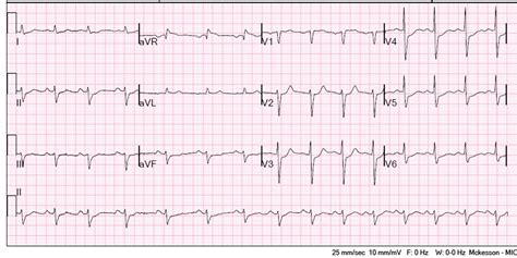 Dr Smiths Ecg Blog Marked St Depression Refractory To Maximal