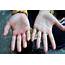 Hand Swelling  Doctor Answers On HealthTap
