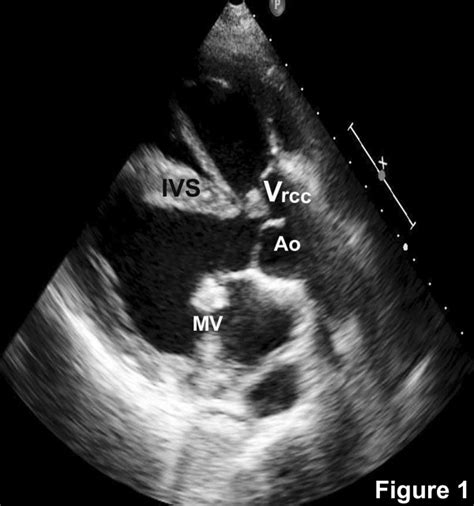 Parasternal Long Axis View Showing The Malaligned Ventricular Septal